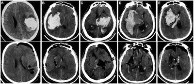 Neuroendoscopy surgery for hypertensive intracerebral hemorrhage with concurrent brain herniation: a retrospective study of comparison with craniotomy